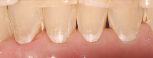 before-after-teeth-image 1 Day 0