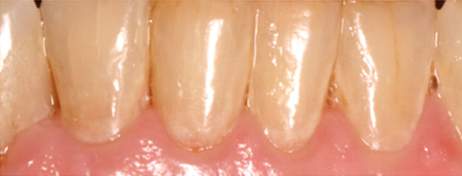 before-after-teeth-image 2 3 month Recall